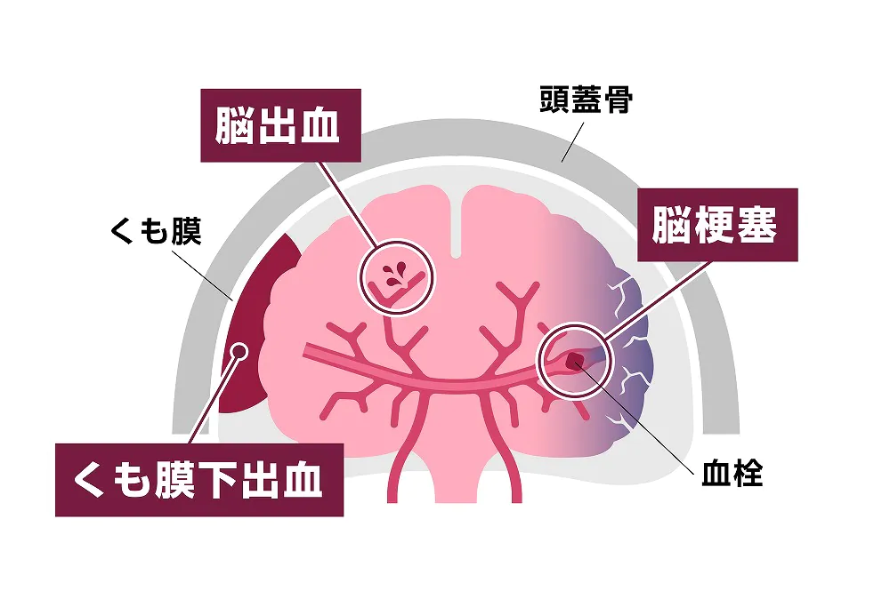 脳梗塞